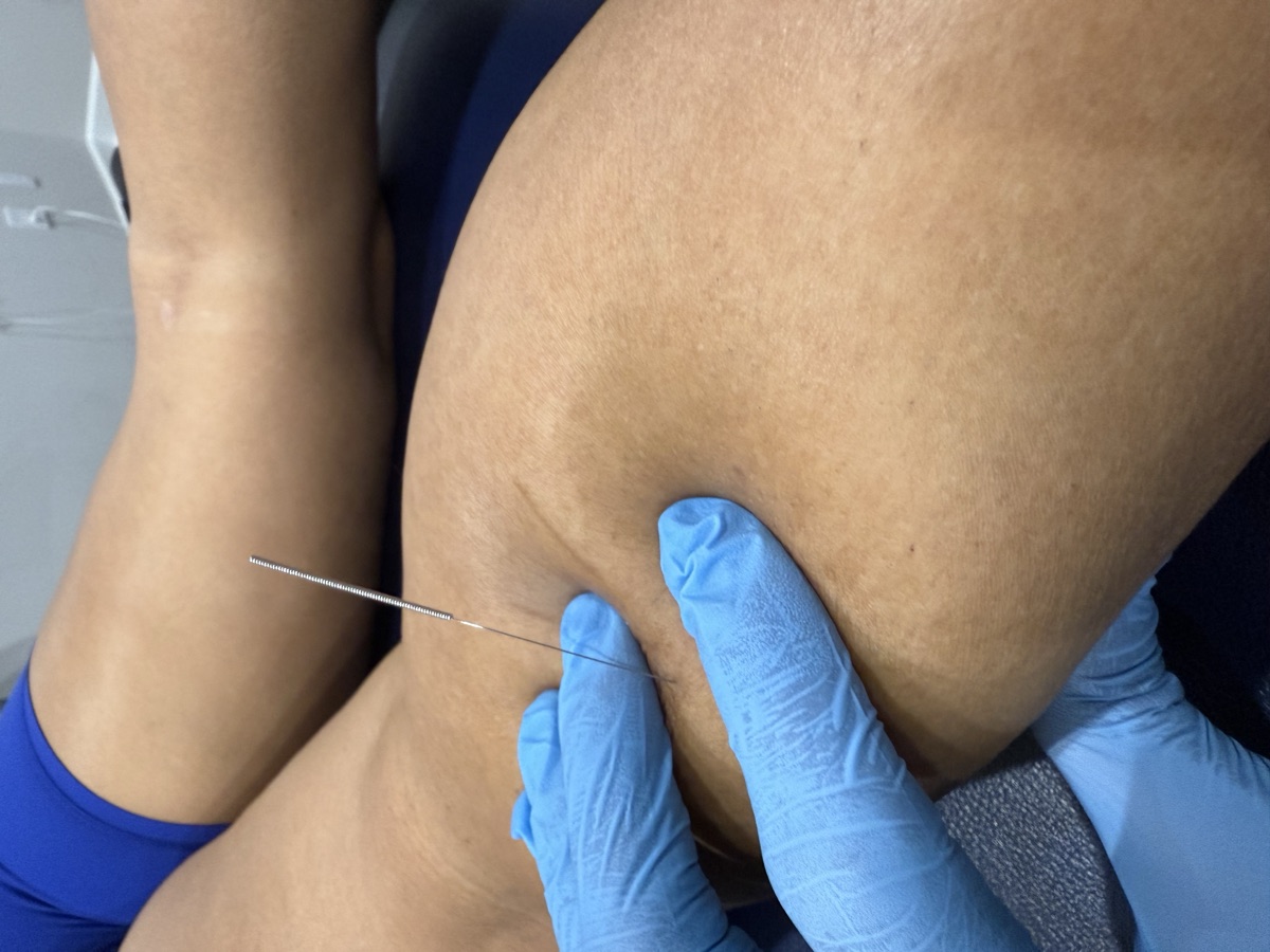 Dry needling manual therapy session at Elev8